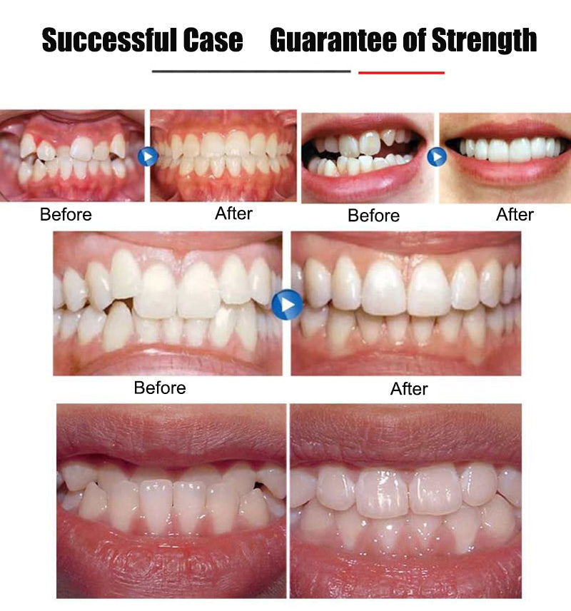 Transparent Orthodontic Braces – Discreet Teeth Alignment System
